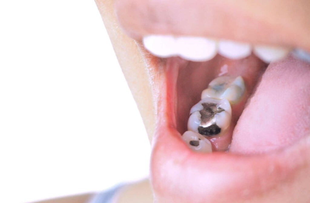 A close-up of a mouth showing teeth with fillings.